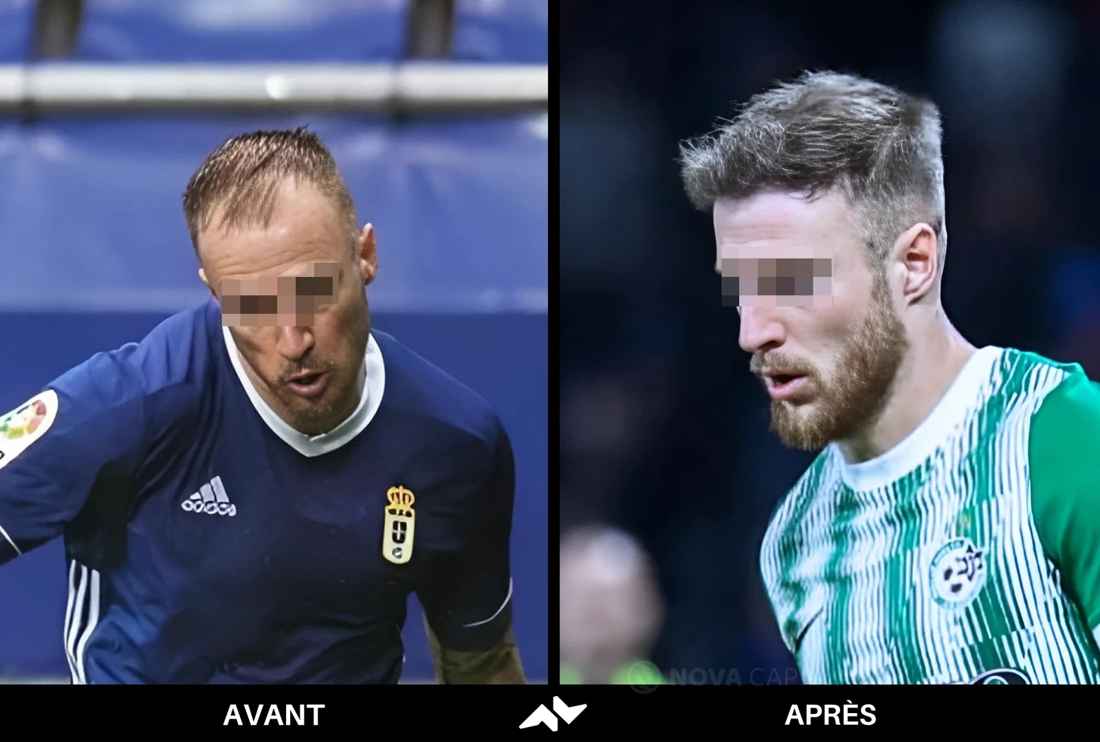 Comparaison avant et après greffe capillaire