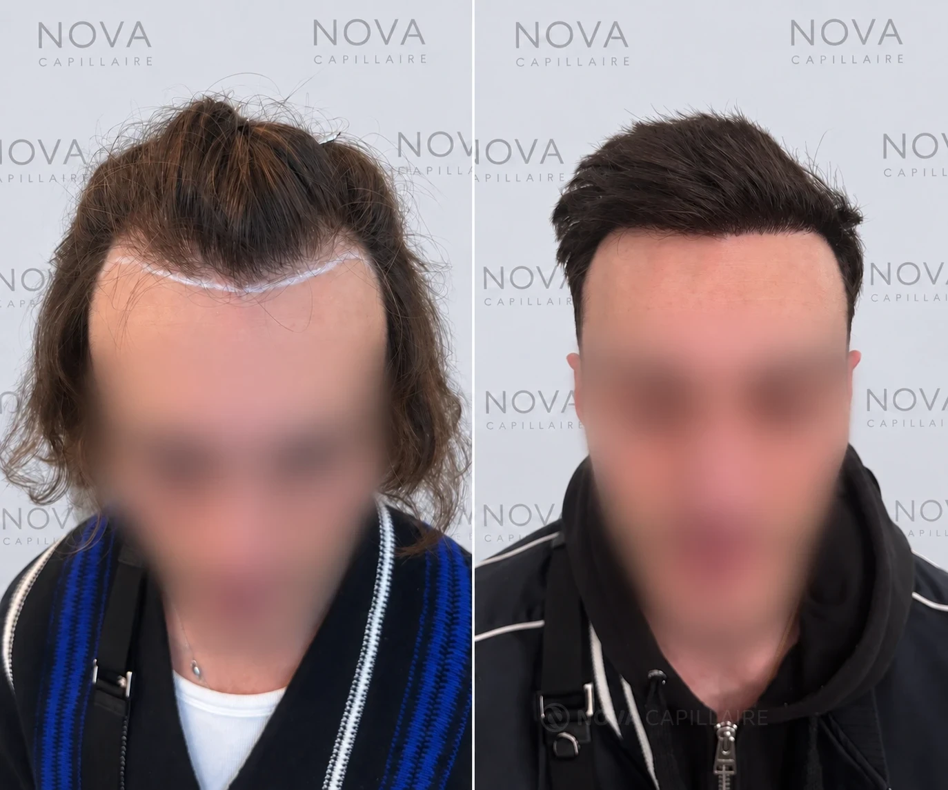 Comparaison avant et après greffe capillaire