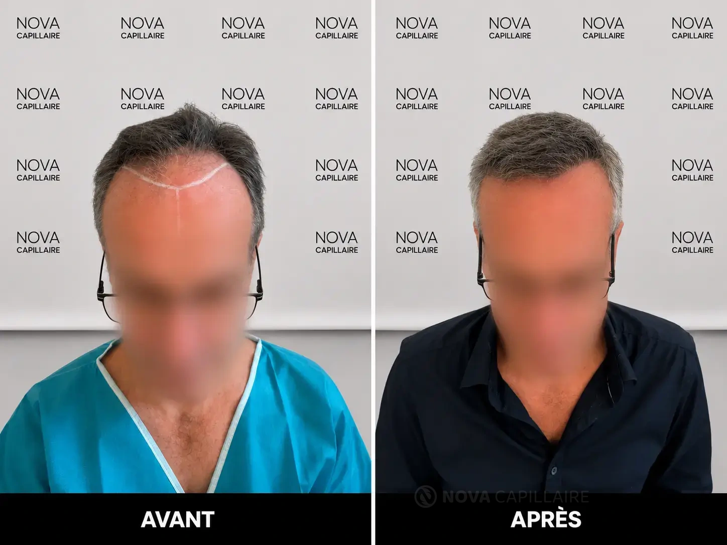Comparaison avant et après greffe capillaire
