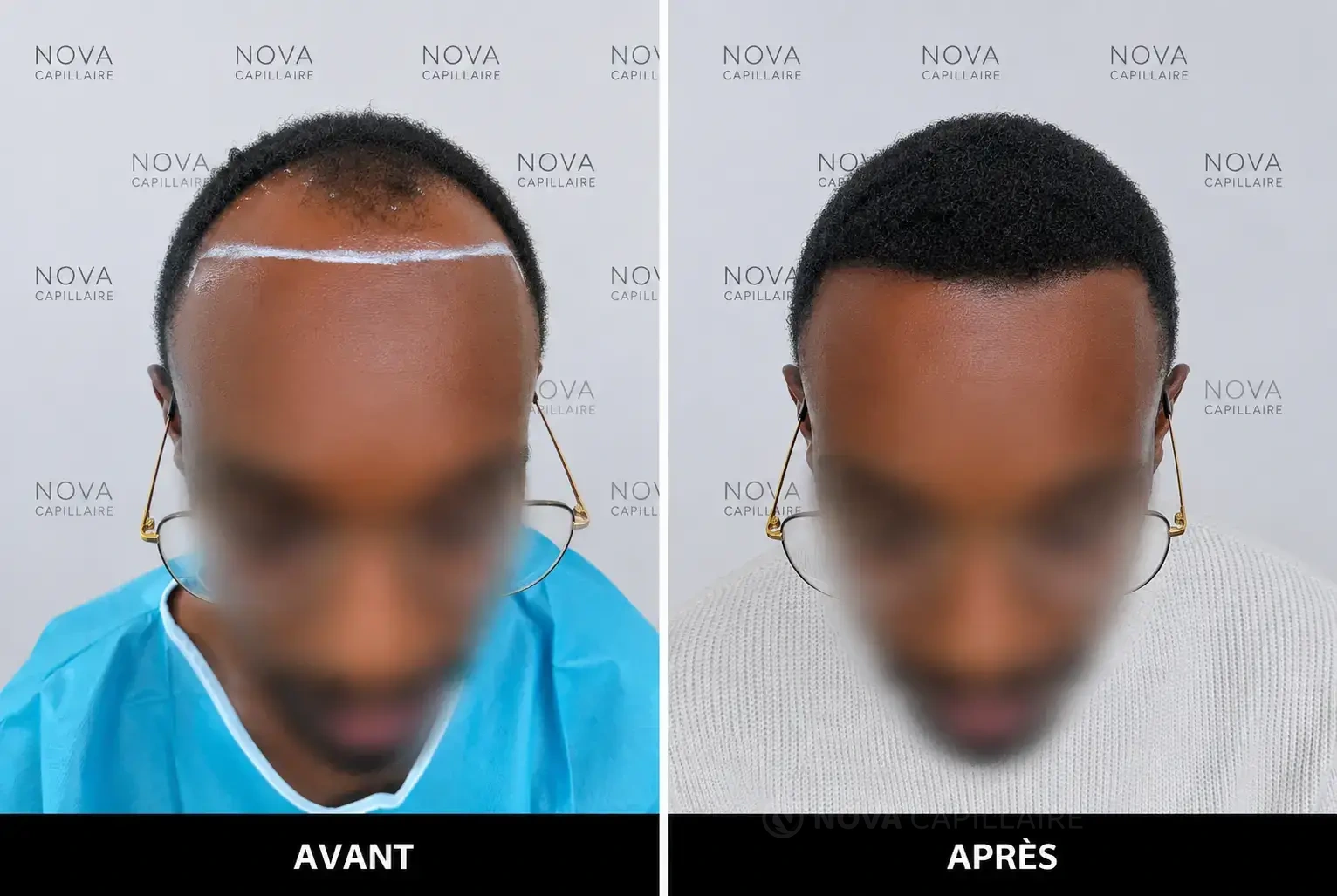 Comparaison avant et après greffe capillaire