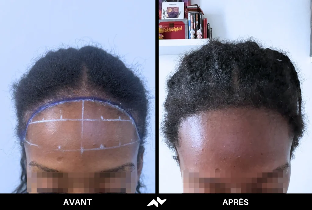Greffe crépus de cheveux avant après