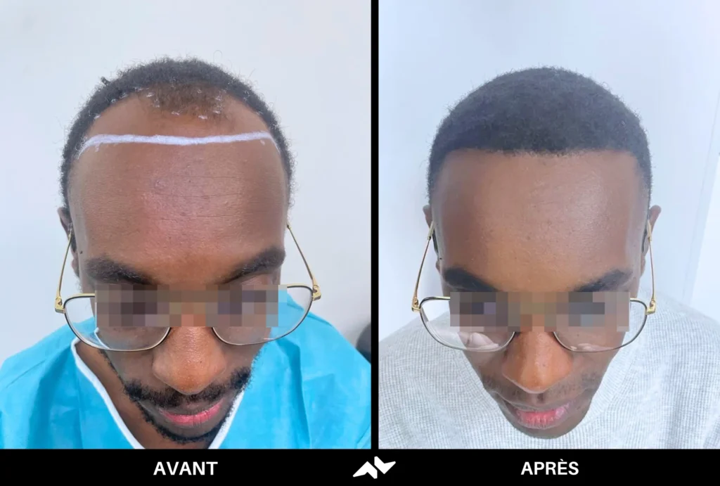 Greffe crépus de cheveux avant après