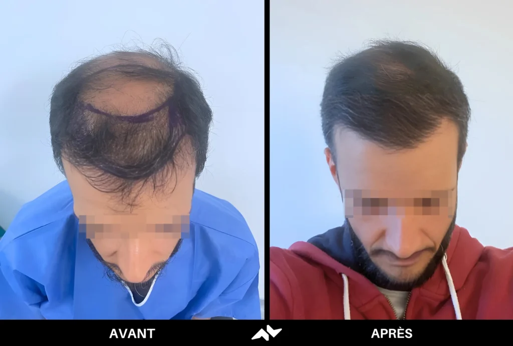 Greffe de cheveux avant après
