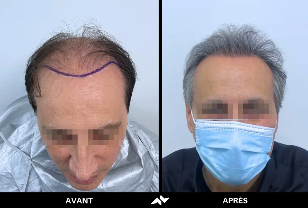 Greffe de cheveux avant après