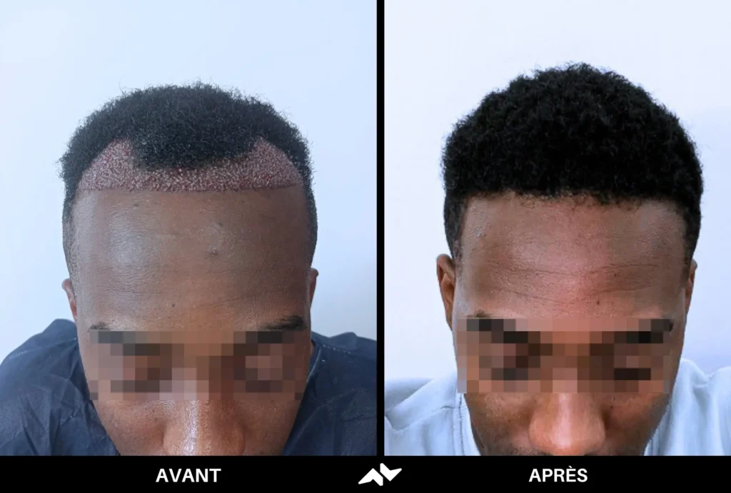 Greffe crépus de cheveux avant après