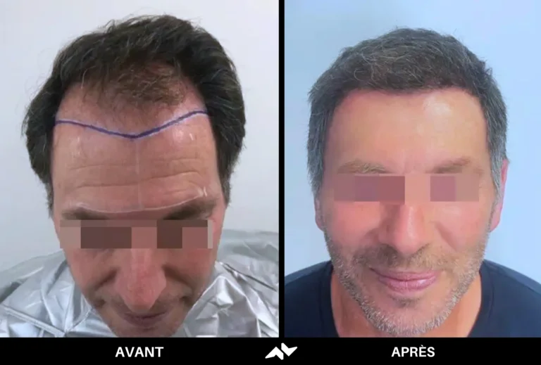 Greffe de cheveux avant après