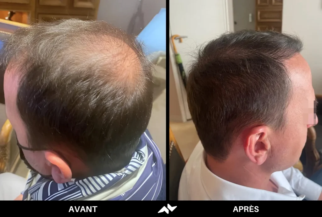 Greffe de cheveux avant après