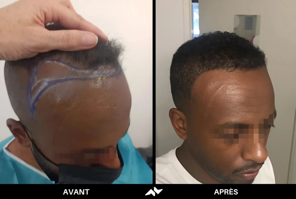 Greffe crépus de cheveux avant après