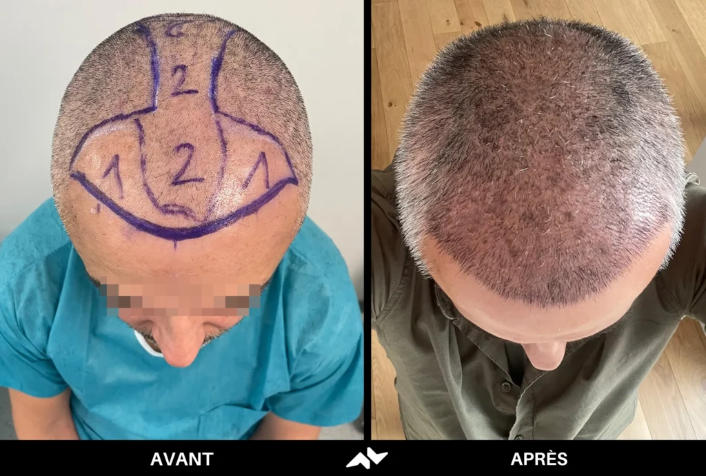 Greffe de cheveux avant après