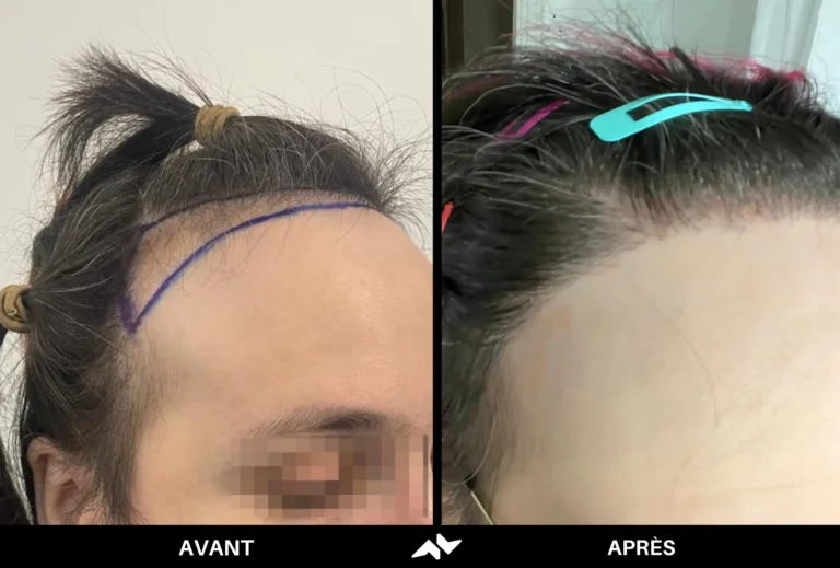 Greffe de cheveux avant après