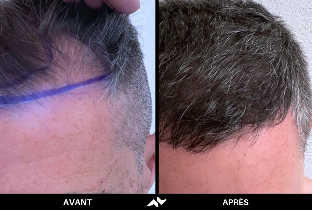 Greffe de cheveux avant après
