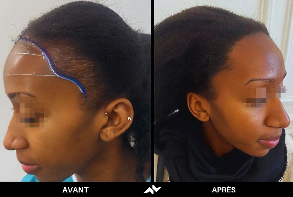 Greffe crépus de cheveux avant après