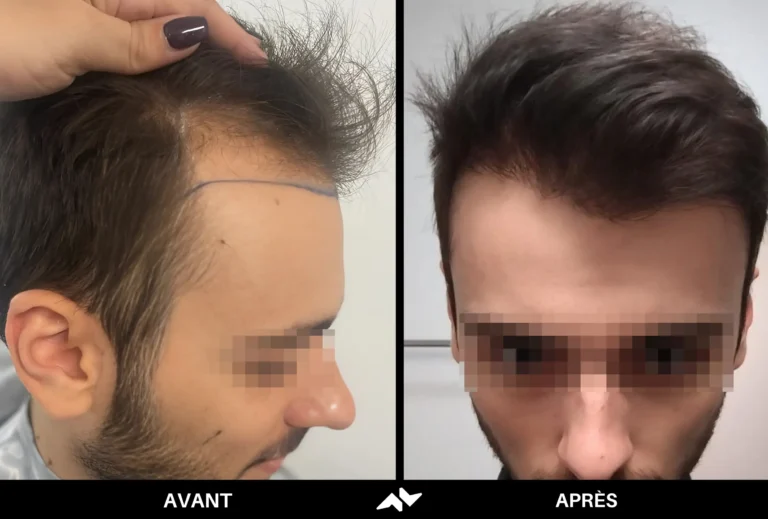 Greffe de cheveux avant après