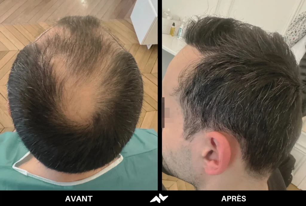 Greffe de cheveux avant après
