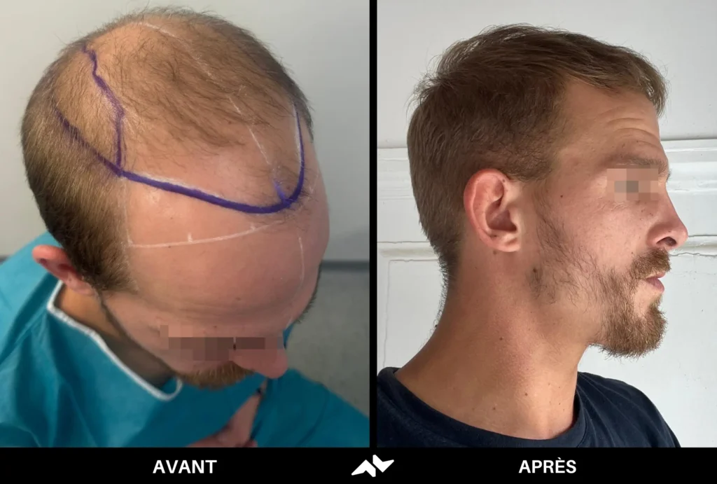 Greffe de cheveux avant après