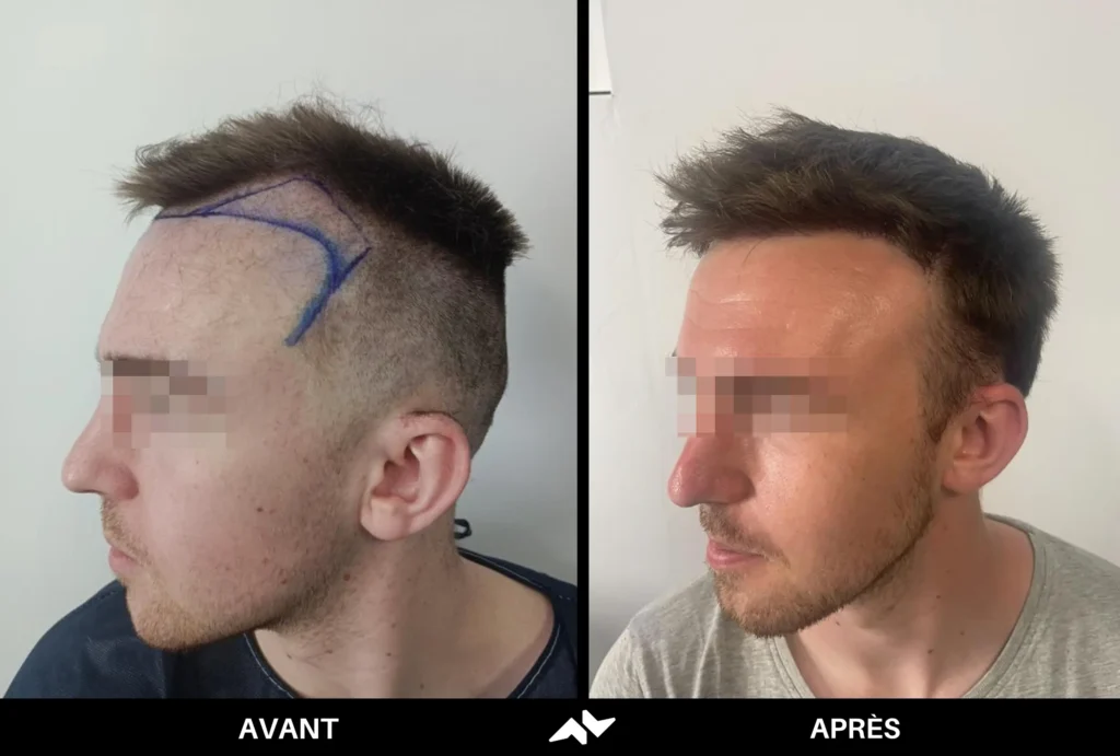 Greffe de cheveux avant après