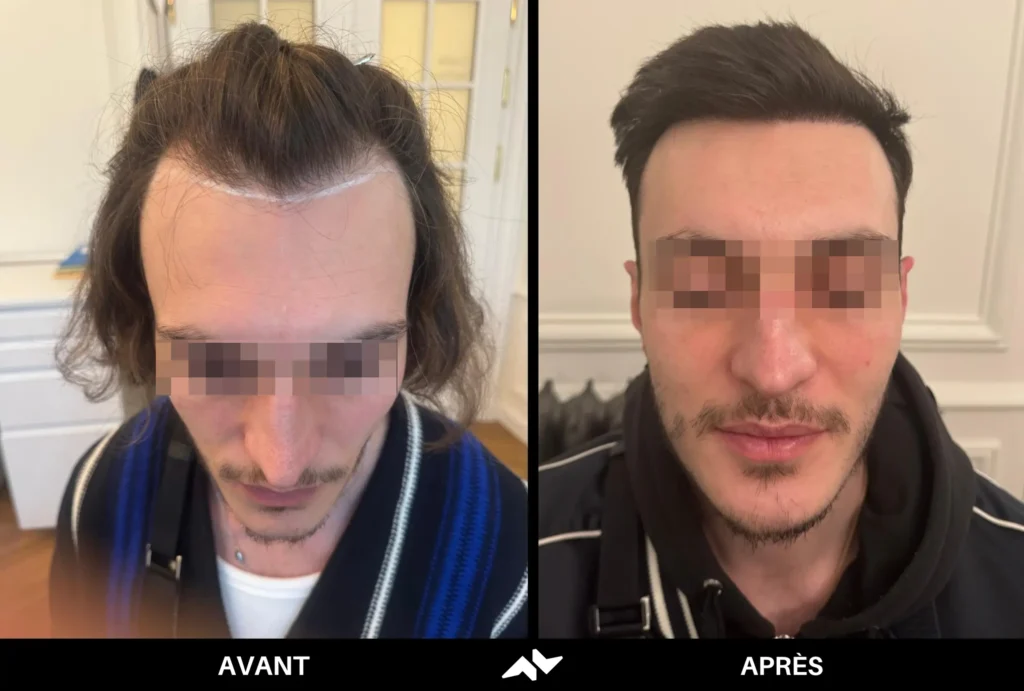 Greffe de cheveux avant après