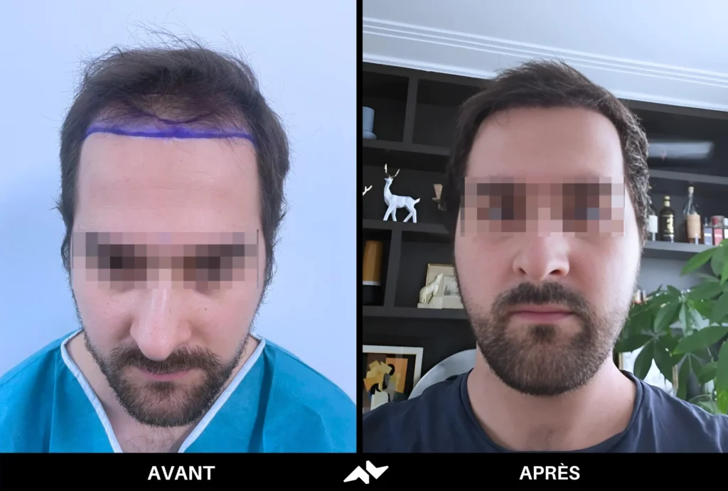 Greffe de cheveux avant après