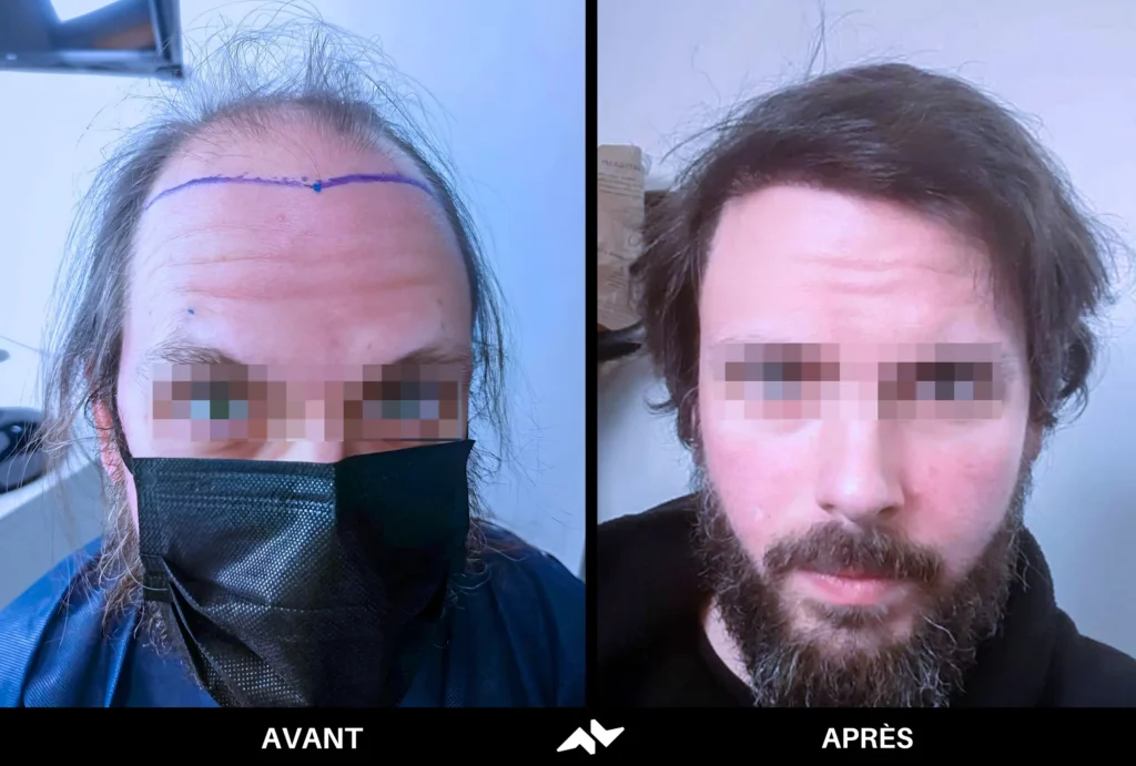 Greffe de cheveux avant après