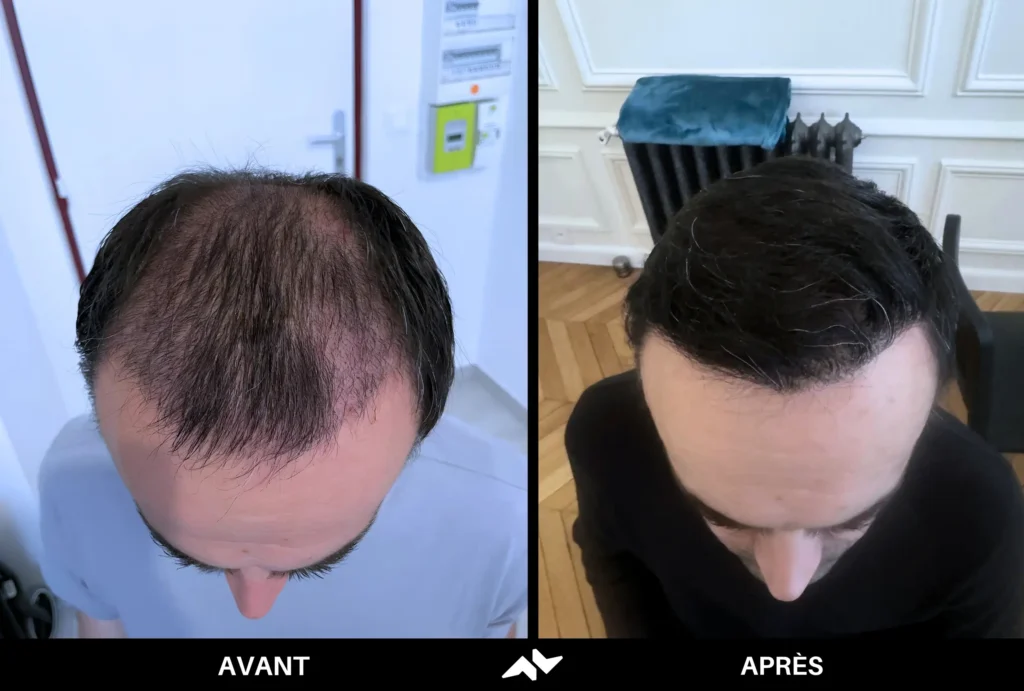 Greffe de cheveux avant après