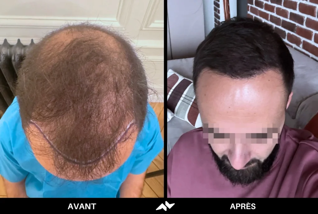 Greffe de cheveux avant après