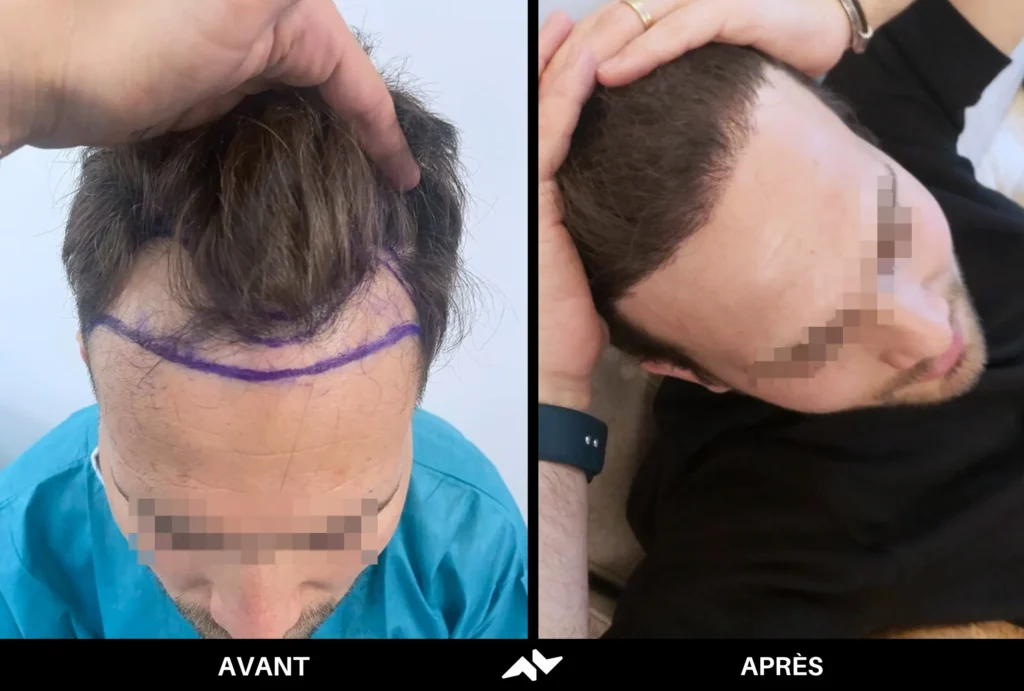 Greffe de cheveux avant après