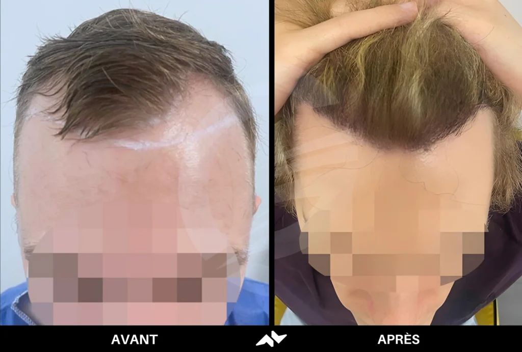 Greffe de cheveux avant après