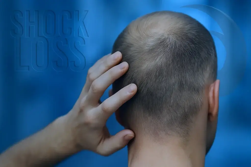 Shock loss après une greffe de cheveux